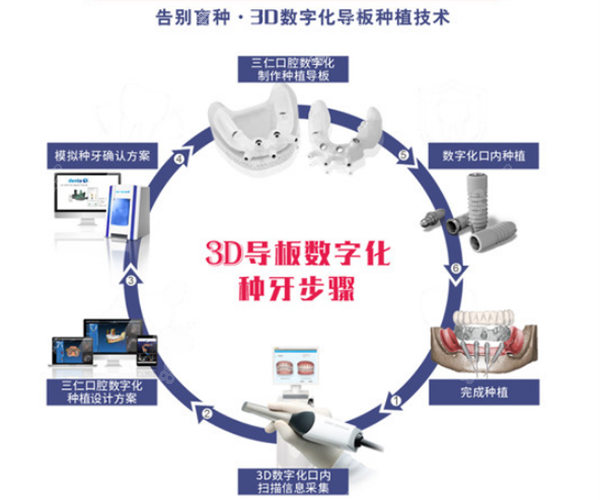 3D数字化种植牙技术