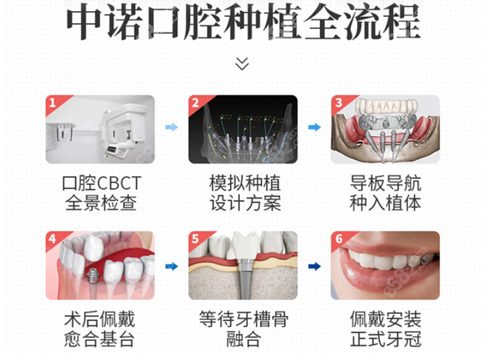 北京中诺口腔医院种植牙流程