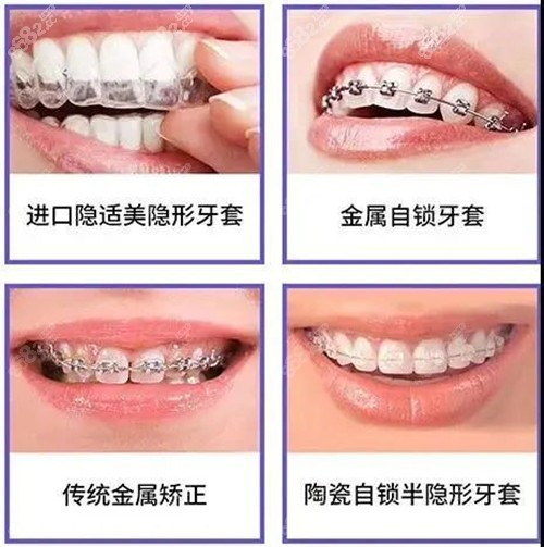 牙齒矯正的不同牙套 牙齒矯正的不同牙套