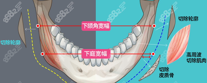 郑康在磨骨做下颌角示意图