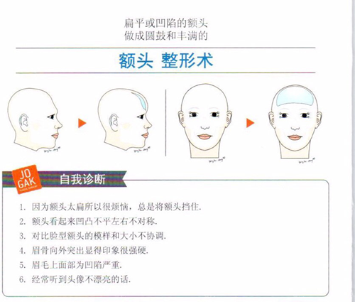 雕刻医院骨水泥填充额头手术