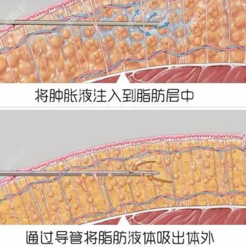 局麻吸脂