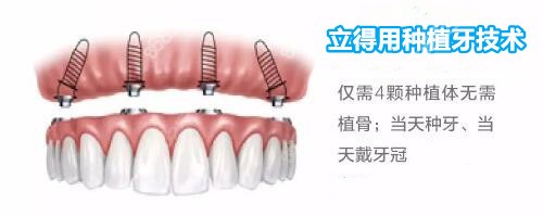 立得用种植牙技术是长沙中诺口腔的招牌
