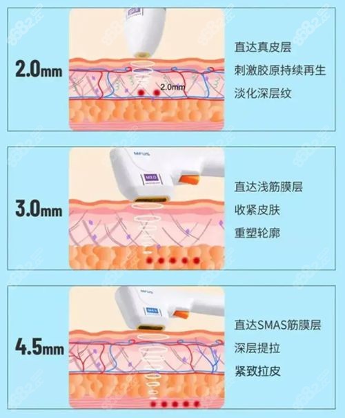 半岛超声炮不同模式除皱功效有区别.jpg