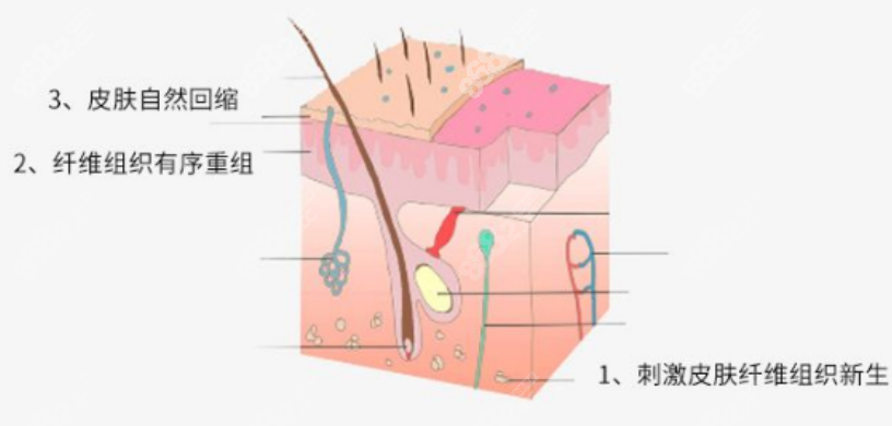 局麻吸脂手术