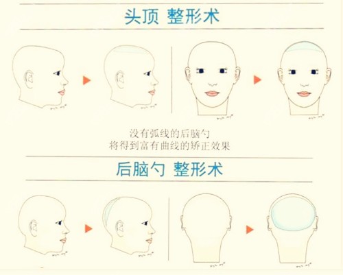韩国雕刻擅长头顶、后脑勺填充手术