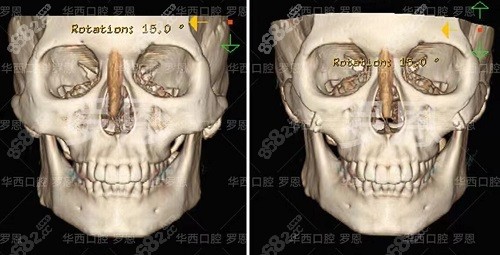 四川友谊<!--<i data=20240705-sp></i>-->颧骨颧弓内推手术