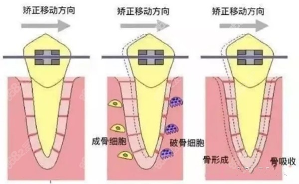 金属牙套的移动位置