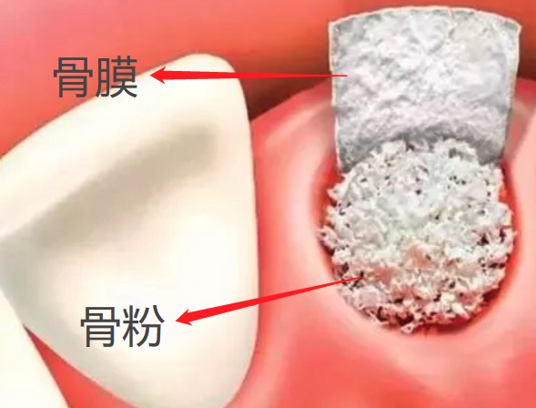 做种植牙为什么要加骨粉？种植牙植骨膜骨粉要另外收费吗?