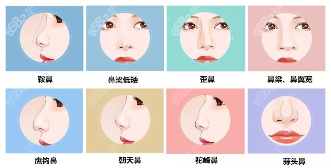 韩国郑东学医生可以改善的鼻子
