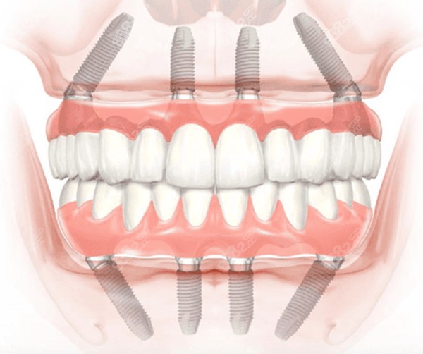 厦门all-on-4全口种植牙的价格