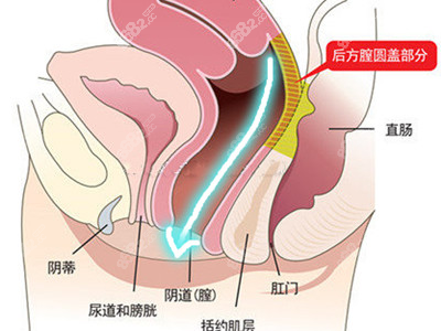 好手艺后方膣圆盖术缩阴位置