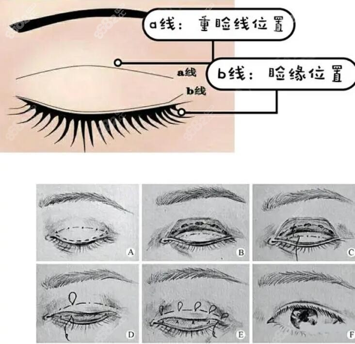 杨丽萍是重庆华美比较出名的眼部医生