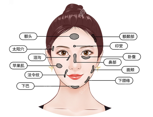 南宁华美常做的面部脂肪填充部位