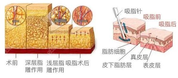 银川华美吸脂技术好吗