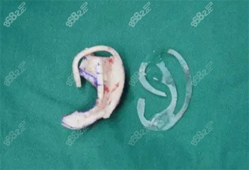 耳再造手術(shù)示意圖
