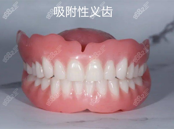 全口吸附性义齿示意图