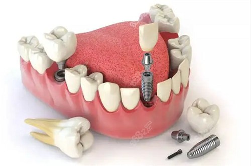 潍坊种植牙价格表