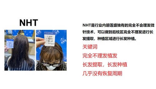 NHT不剃发植发
