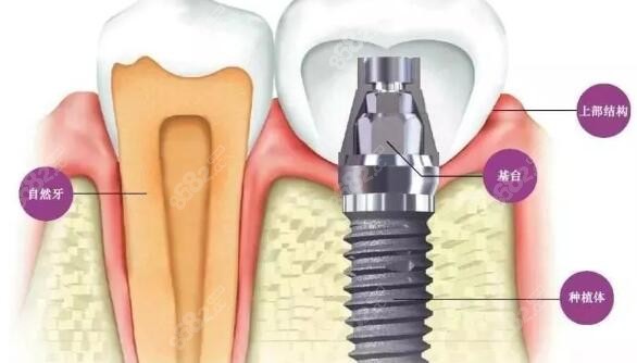 大冶咿呀口腔种植牙价格