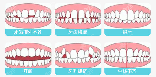 钦州康美口腔常做的牙齿矫正类型图
