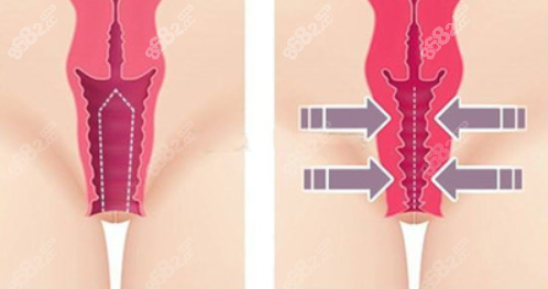 韩国缩阴手术前后对比