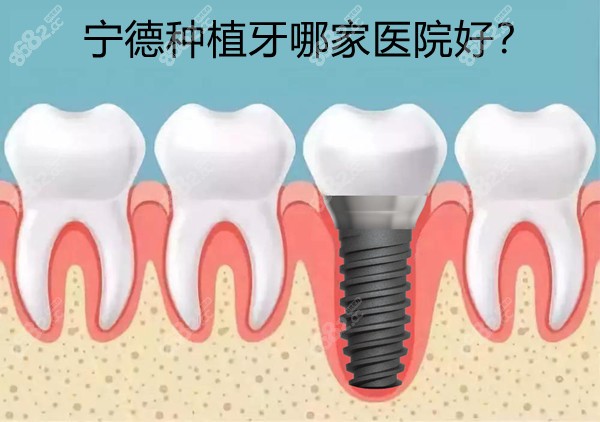 宁德种植牙哪家医院好