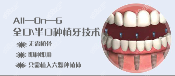 厦门all-on-6全口种植牙的费用