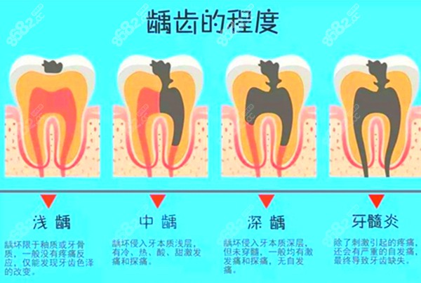 龋坏的程度图