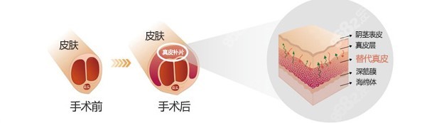 韩国世檀塔医院真皮生物补片增粗阴茎图片