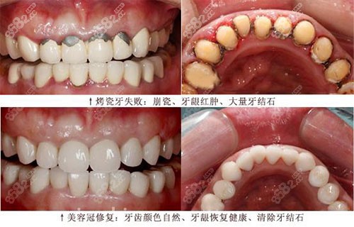 被骗做了烤瓷牙每天都很抑郁