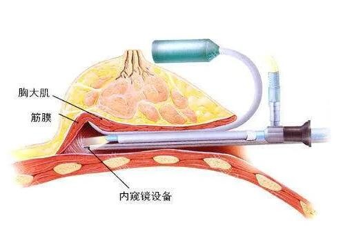 乌鲁木齐华美内窥镜隆胸技术