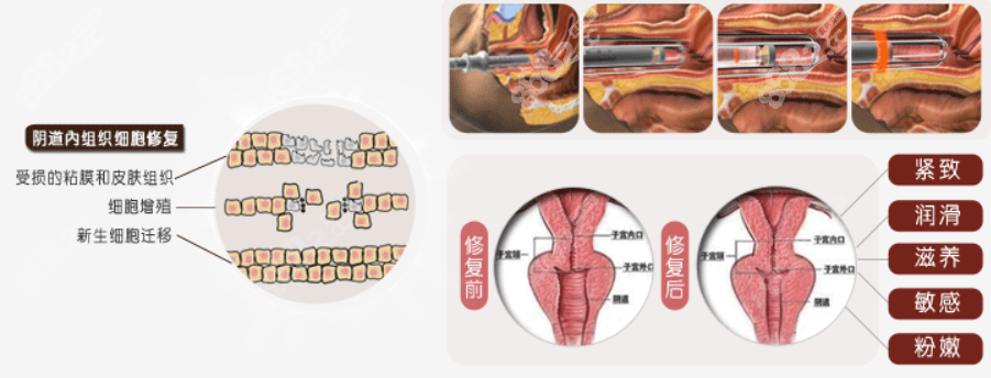 韩国如妍妇科激光缩阴前后对比