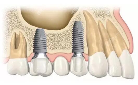 石家莊冀城口腔種植牙價格表 石家莊冀城口腔種植牙價格表