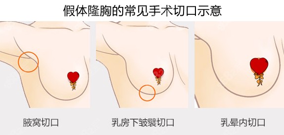 假体隆胸的常见手术切口示意
