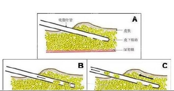 银川丽都吸脂技术