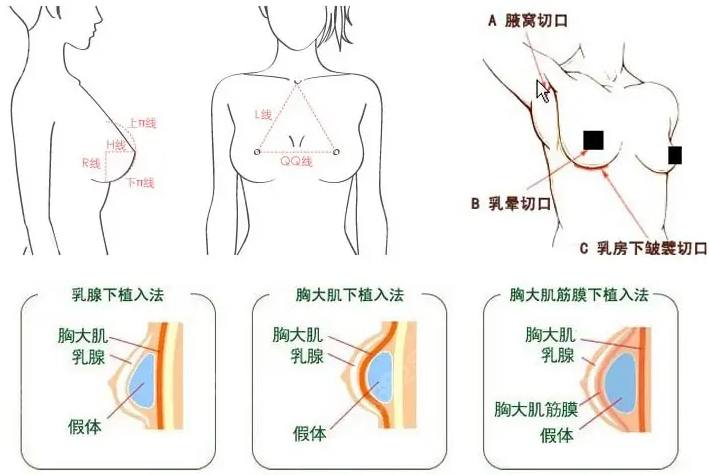 杭州美莱整形医院栗勇做胸怎么样