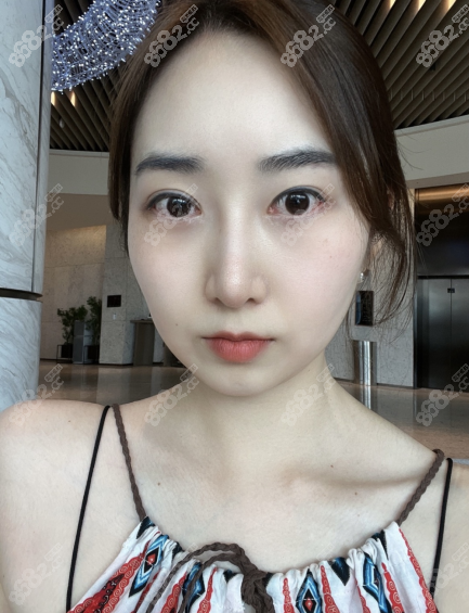在韩国做隆鼻和双眼皮一个月多恢复图