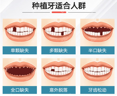 钦州康美口腔做种植牙的类型图