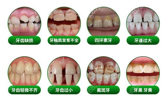 台江区烤瓷牙、全瓷牙多少钱一颗