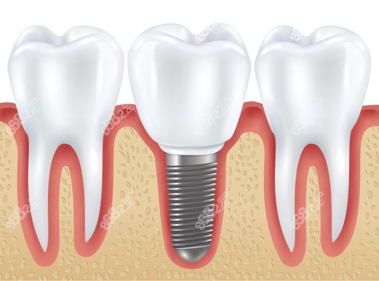 鼎植口腔的韩国种植牙价格