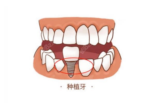 舟山种植牙价格一览表