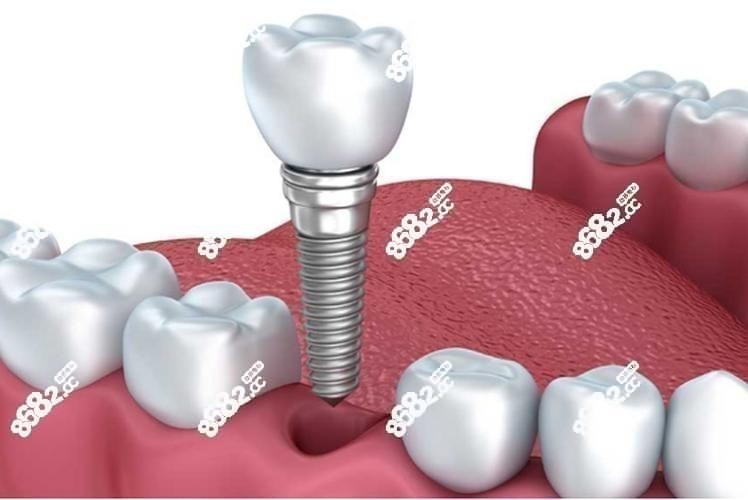 种植牙结构示意图