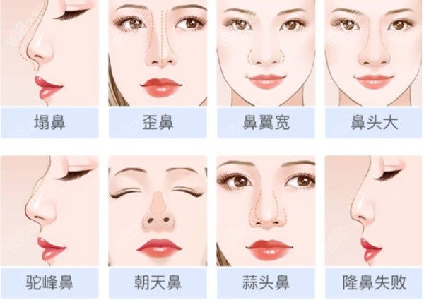合肥恒美陈浩医生做鼻子怎么样