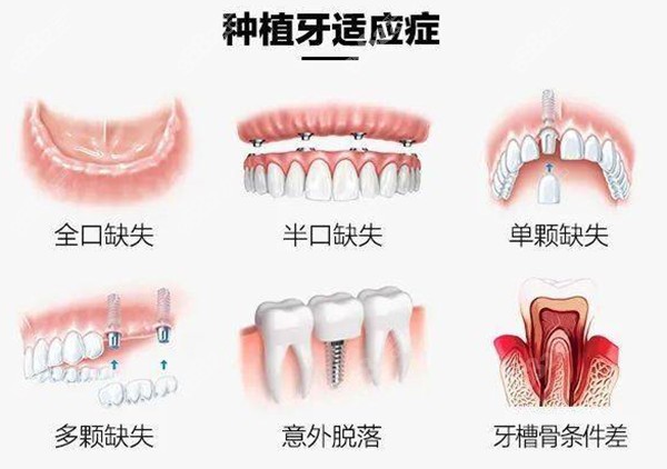 福州台江种植牙多少钱一颗