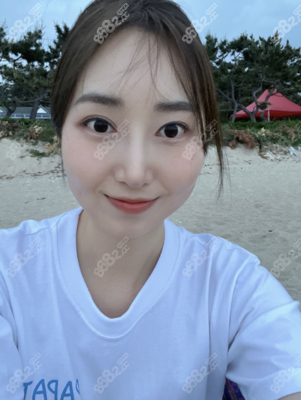 在韩国做双眼皮修复和隆鼻恢复图参考