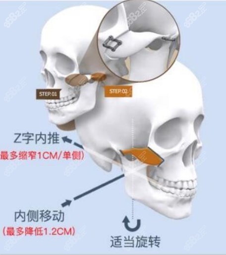 m.8682.cc广州美恩医院颧骨内推技术优势