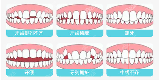 钦州康美口腔常做的牙齿矫正类型图