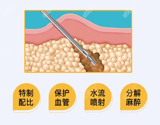 <!--<i data=20240705-sp></i>-->整形吸脂怎么样
