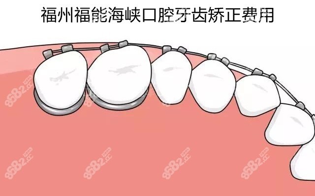 福州福能海峡口腔牙齿矫正费用